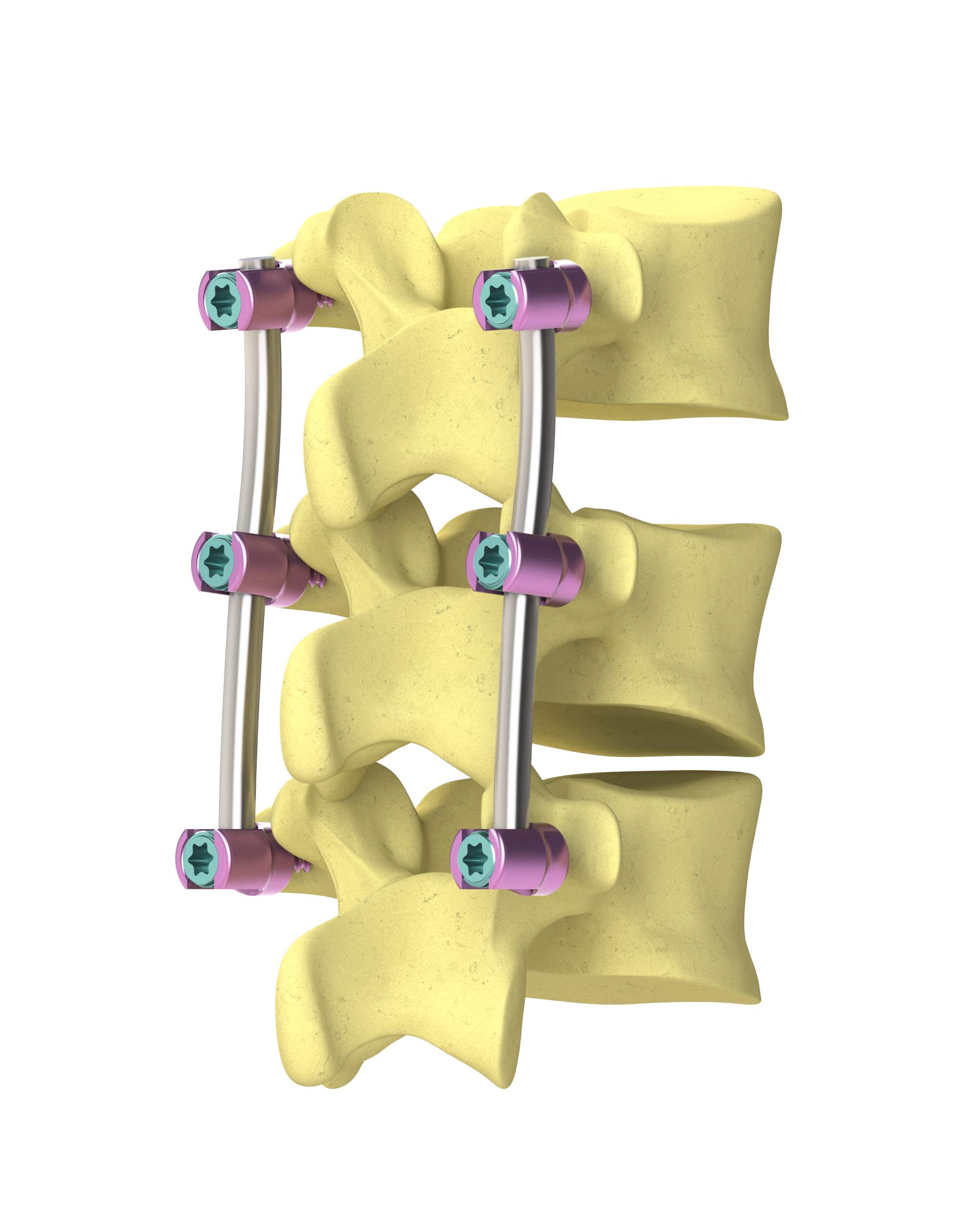 pedicle